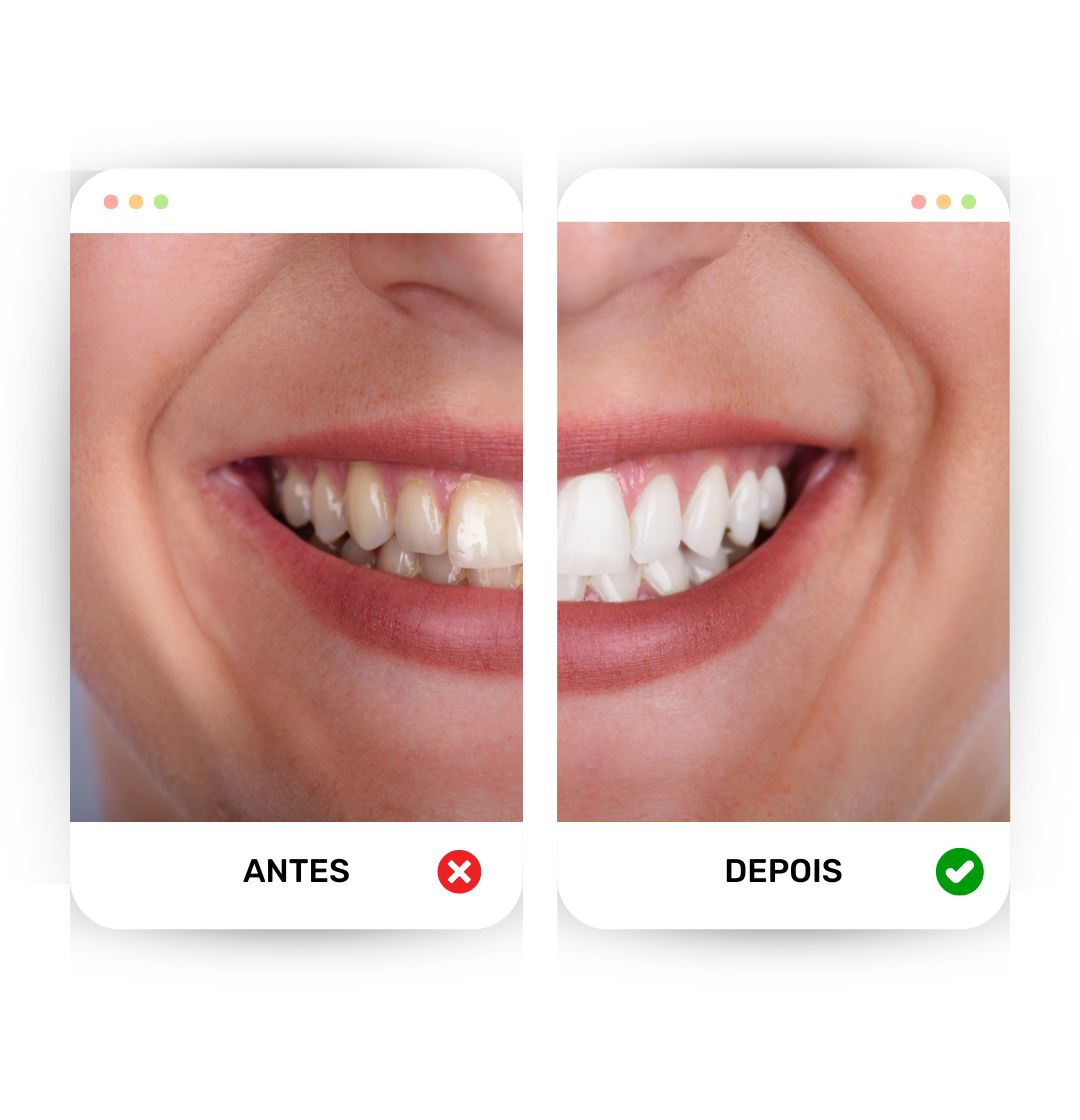 Teeth Clareador - Adeus, dentes amarelados! (Compre 1 Ganhe 2)