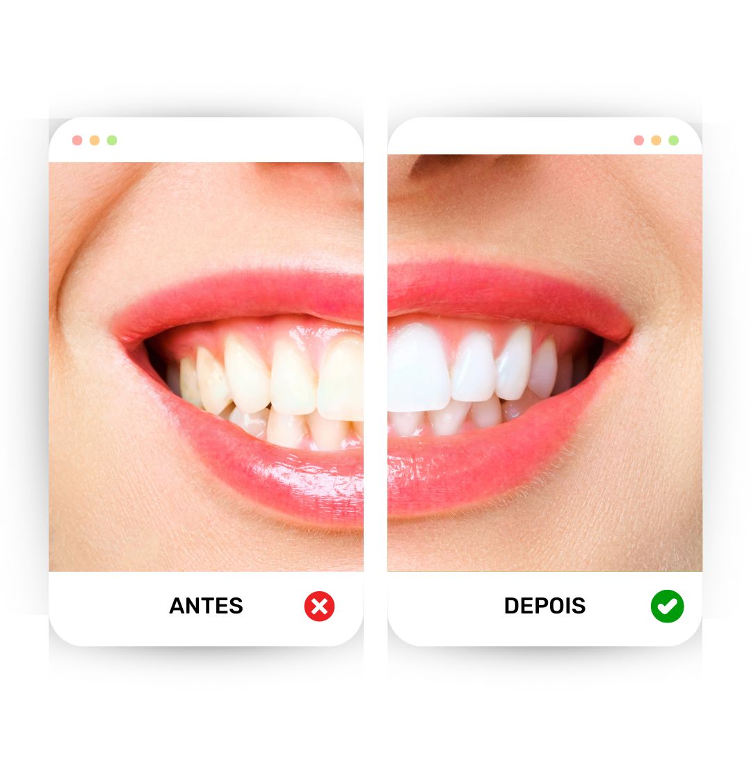 Teeth Clareador - Adeus, dentes amarelados! (Compre 1 Ganhe 2)